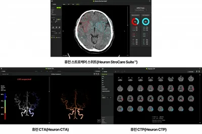 휴런, 모든 뇌졸중 CT 검사 솔루션 ‘상용화 성공’